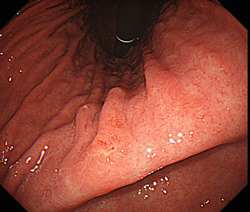 図　胃NHPH感染の内視鏡像